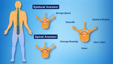 epidural anestezi yan etkileri nasıl geçer